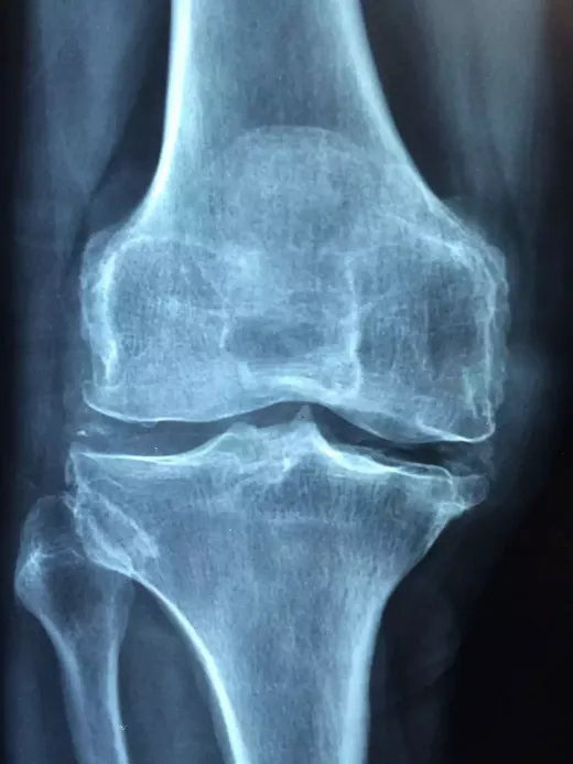 Woman's Health Concerns and Osteoporosis